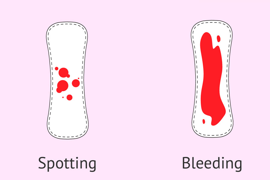 تفاوت لکه بینی و خونریزی در بارداری