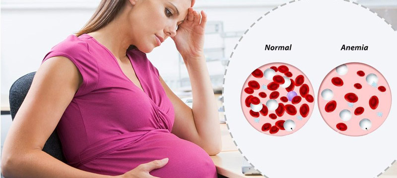 کم خونی در زنان باردار